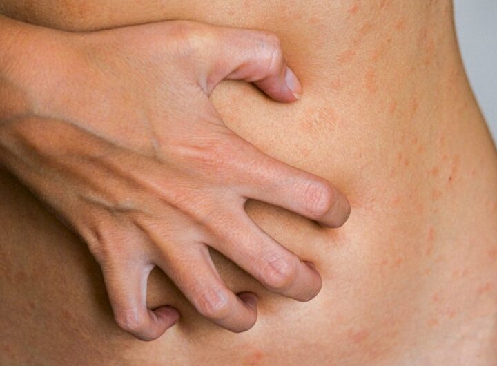 Understanding Psoriasis: How it Can Affect Your Daily Life